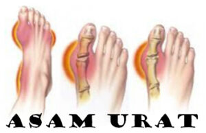 Tanaman Obat Herbal Untuk Asam Urat
