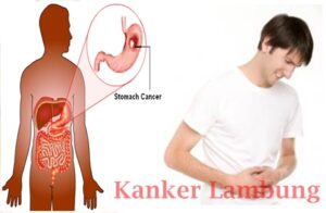 Memecah Misteri Obat Alami Kanker Lambung